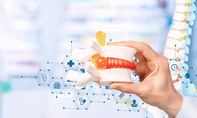 2632208 Minimally invasive spinal model with highlighted nerve and disc, representing advanced pain management and orthopedic care at Performance Pain and Sports Medicine.