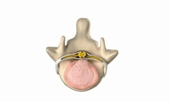 2637688 Spinal nerve root illustration for pain management and sports medicine treatment.