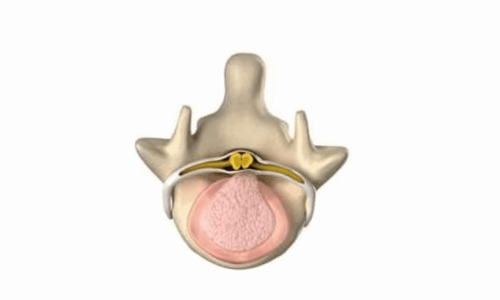 Spinal nerve root illustration for pain management and sports medicine treatment.