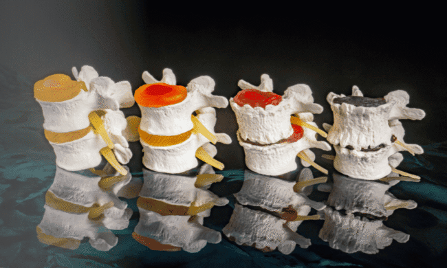 2682108 Spinal disc model showing herniated discs and nerve compression for pain relief and sports medicine treatment.