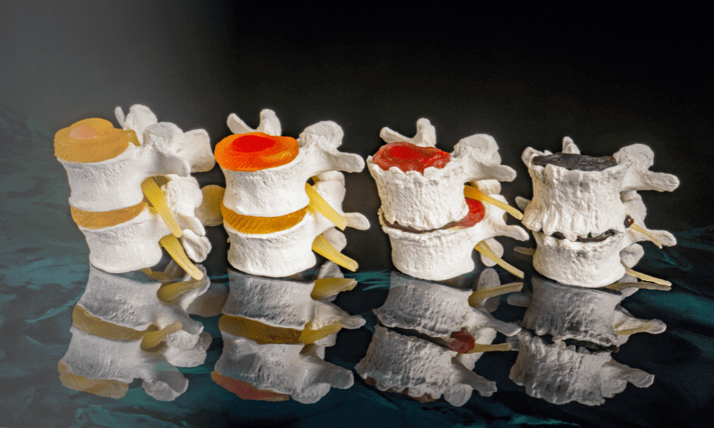Spinal disc model showing herniated discs and nerve compression for pain relief and sports medicine treatment.