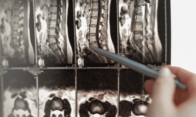 2687114 MRI spinal scan showing herniated disc and nerve compression for sports injury evaluation.