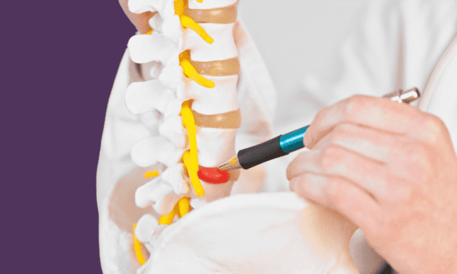 2708604 Pinched nerve treatment in spinal model with medical professional demonstrating nerve compression relief methods for pain management.