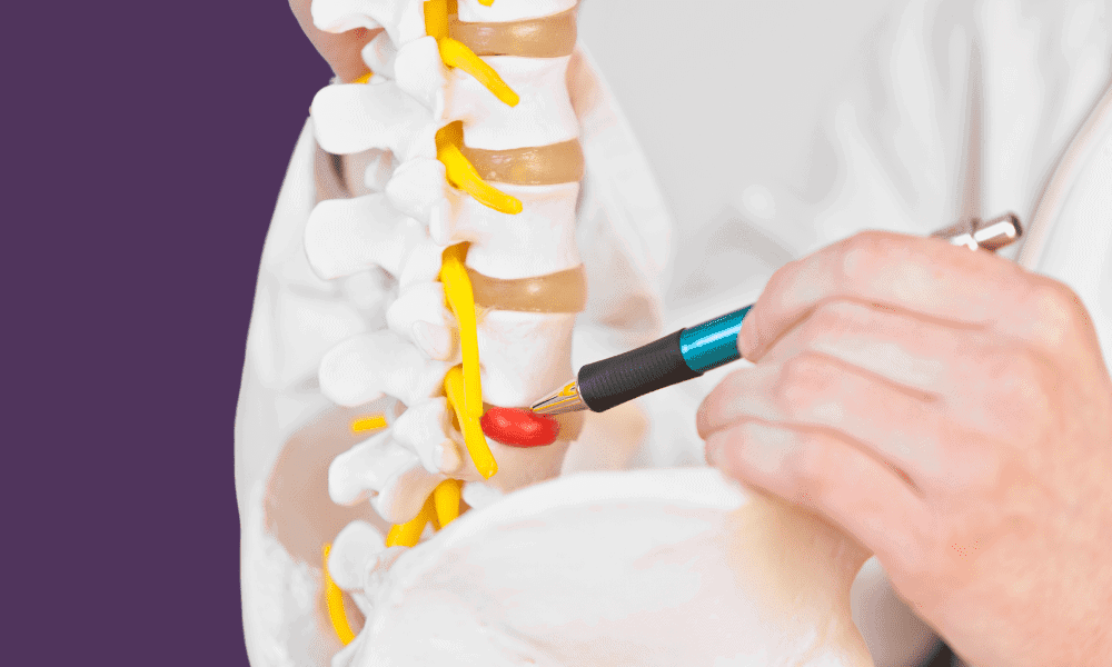 2708604 Pinched nerve treatment in spinal model with medical professional demonstrating nerve compression relief methods for pain management.