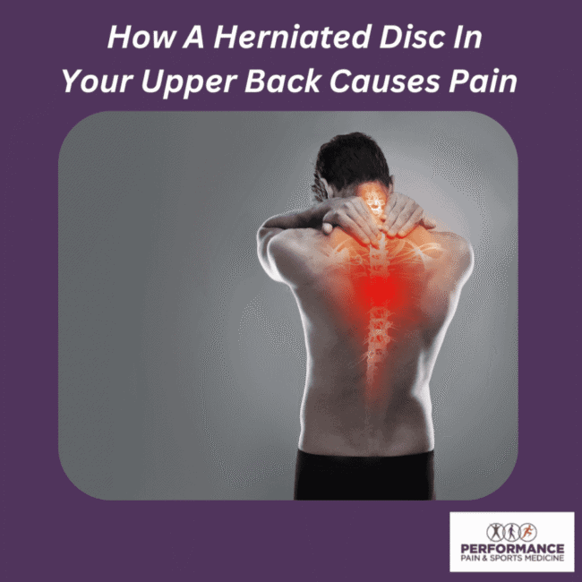 2739288 Herniated disc pain upper back, spine inflammation, spinal disc injury, back pain relief, sports medicine herniated disc treatment.
