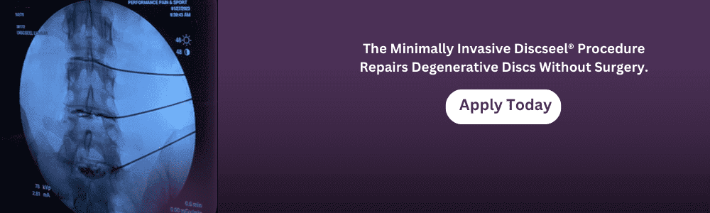 Minimally invasive discseel procedure for repairing degenerative discs without surgery in sports medicine and pain management.