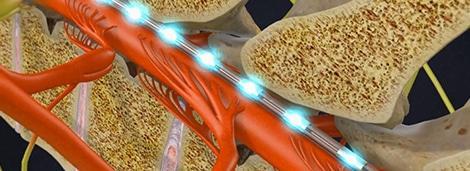 Medical illustration of spinal cord stimulator leads delivering electrical pulses along the spinal cord between vertebrae