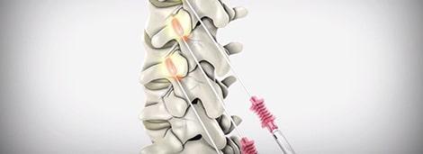 Spinal injection procedure for pain relief, demonstrating epidural injections with a medical needle and spinal anatomy, used in sports medicine and pain management.