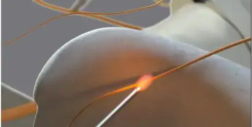 Minimally invasive shoulder repair procedure performed by Performance Pain and Sports Medicine specialists.