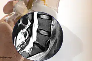 Spinal MRI showing herniated disc and nerve impingement for back pain relief.
