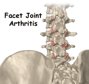 Facet joint arthritis in the spine, showing inflammation and degeneration in vertebral joints for effective pain management and sports medicine treatment.