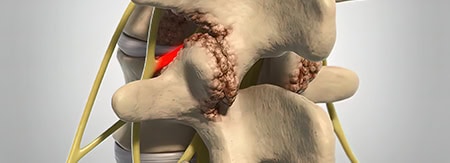 Minimally invasive spine surgery model showing detailed spinal structures and surgical tools for pain management and sports medicine treatment.