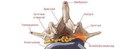Detailed medical illustration of a human vertebra showing spinal structures, nerve roots, and discs, used in sports medicine and pain management.