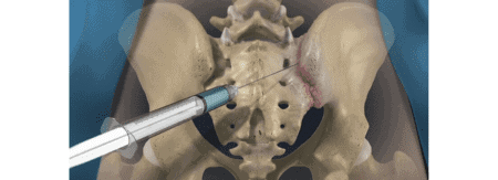 A medical model of the pelvis showing a minimally invasive injection procedure for pain relief or treatment.