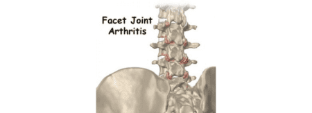 Facet joint arthritis in the lumbar spine, highlighting common cause of back pain and targeted treatments at Performance Pain and Sports Medicine.