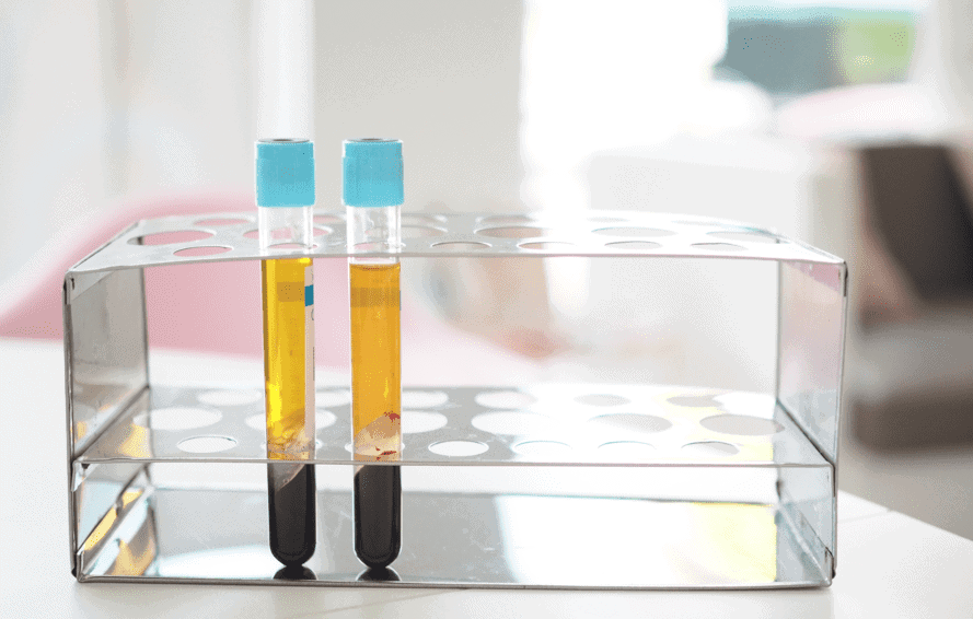 Blood sample test tubes in a laboratory rack for medical diagnostics and sports medicine testing, emphasis on pain management and injury recovery.
