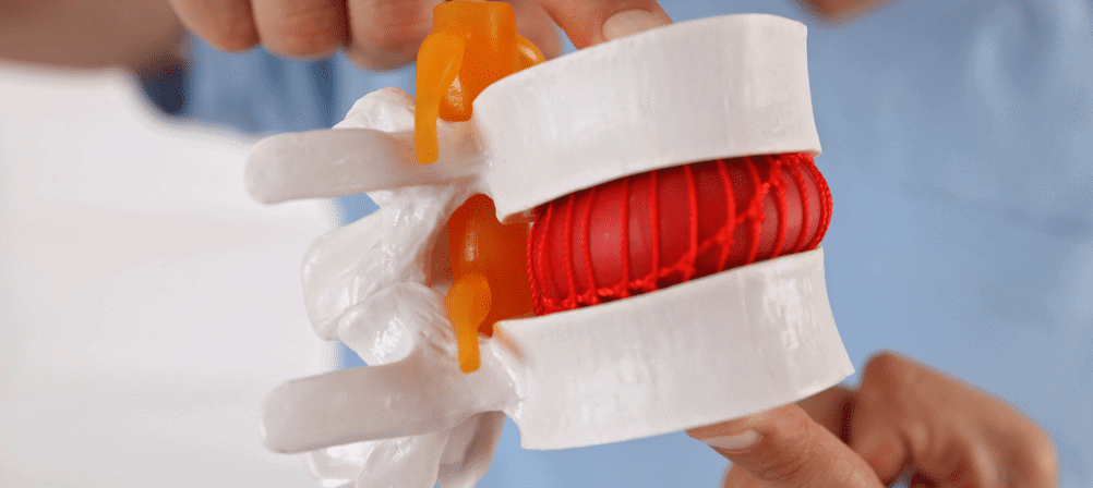 Herniated disc model showing disc herniation and nerve compression, illustrating common spine injuries managed at Performance Pain and Sports Medicine.