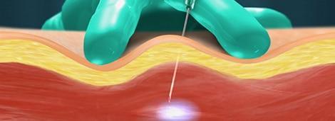 Laser skin treatment for pain relief and skin rejuvenation at Performance Pain and Sports Medicine.