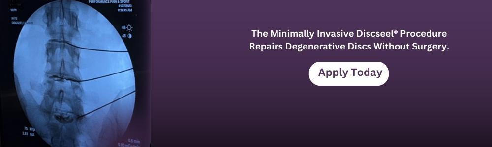 Minimally invasive Discseel procedure for repairing degenerative discs without surgery at Performance Pain and Sports Medicine.