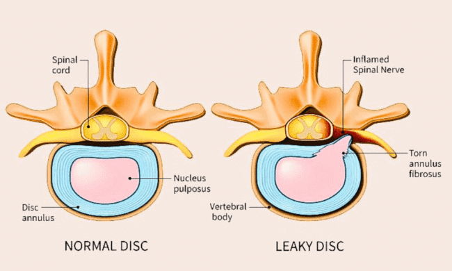 2633387 (2) Torn disc with inflamed spinal nerve and fibrous tissue compared to a normal disc, illustrating herniated disc effects on spinal nerves and vertebral health.