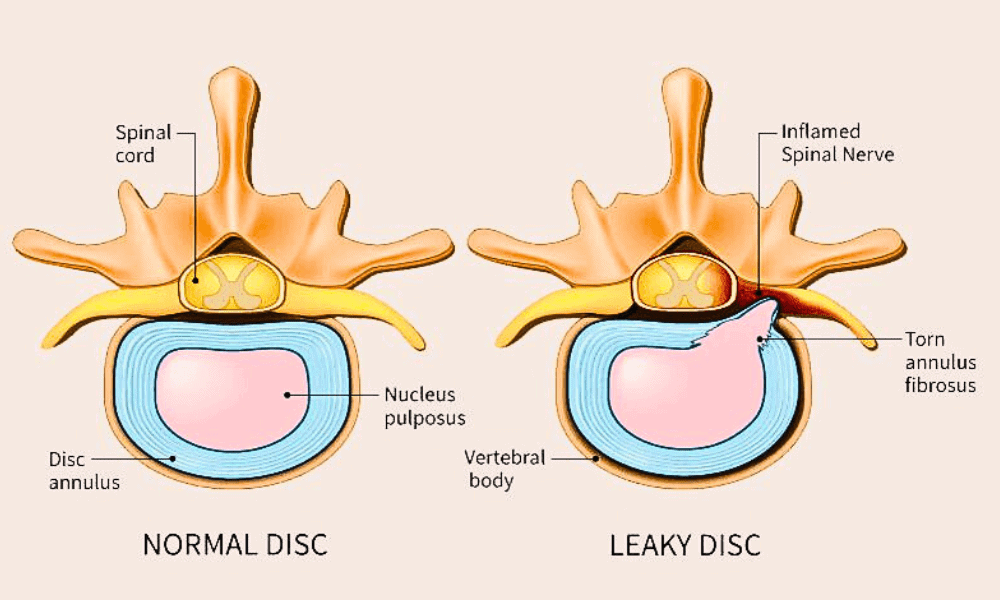Torn disc with inflamed spinal nerve and fibrous tissue compared to a normal disc, illustrating herniated disc effects on spinal nerves and vertebral health.